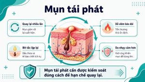 mụn tái phát