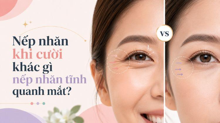Phân biệt nếp nhăn động và nếp nhăn tĩnh quanh mắt