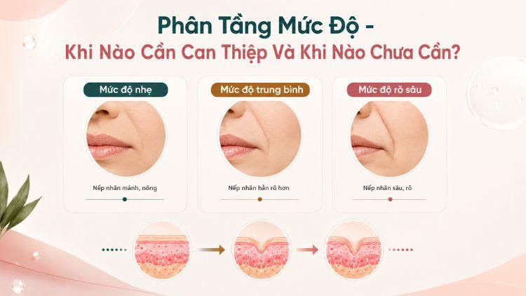 Minh họa các mức độ nếp nhăn khóe miệng thường gặp