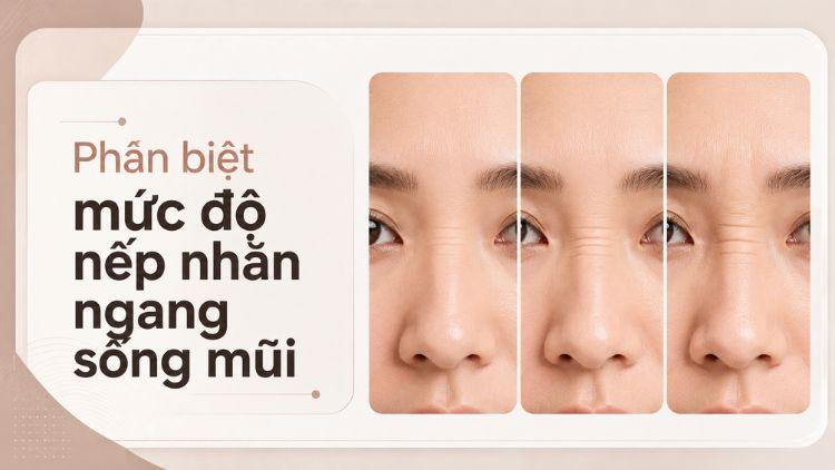 Các mức độ bunny lines từ nhẹ đến hằn tĩnh rõ