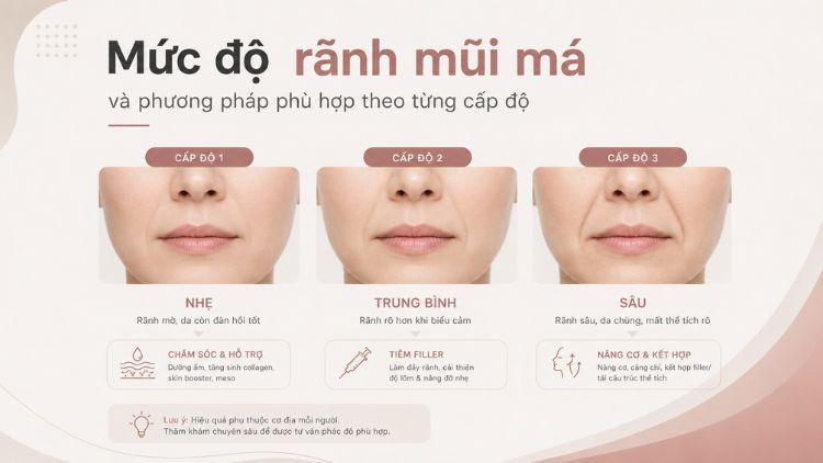 Các mức độ rãnh mũi má từ nhẹ đến sâu
