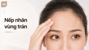 nếp nhăn vùng trán