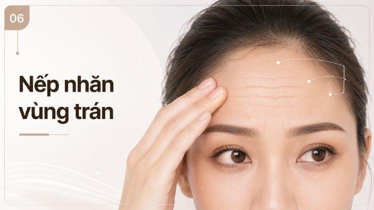 nếp nhăn vùng trán