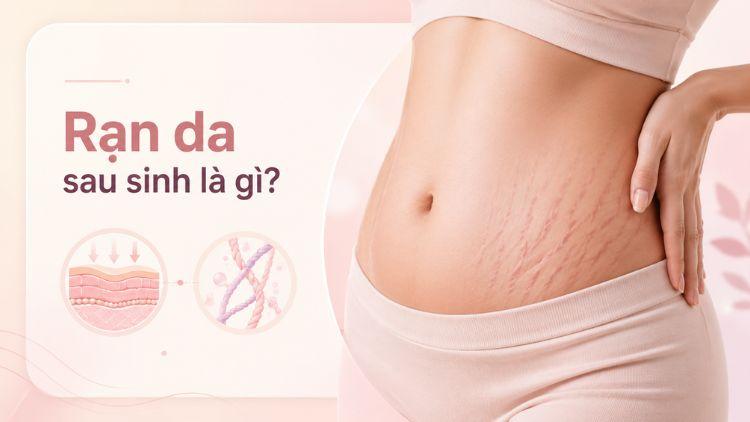 Các vết rạn da thường xuất hiện sau thai kỳ