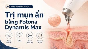 trị mụn ẩn bằng Fotona Dynamis Max