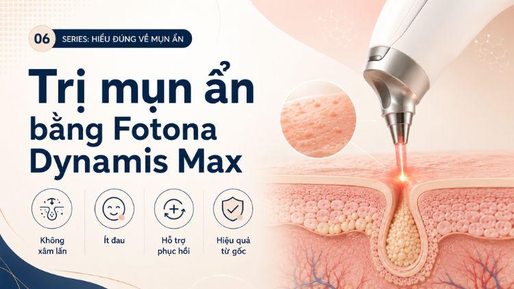 trị mụn ẩn bằng Fotona Dynamis Max