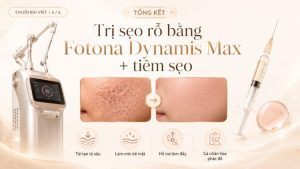 Trị sẹo rỗ bằng Fotona Dynamis Max + tiêm sẹo