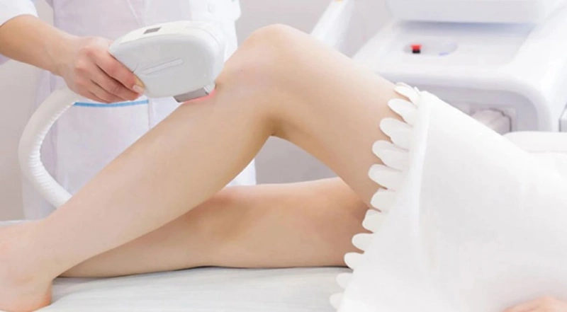 Triệt lông IPL tại Citrine Derma Clinic