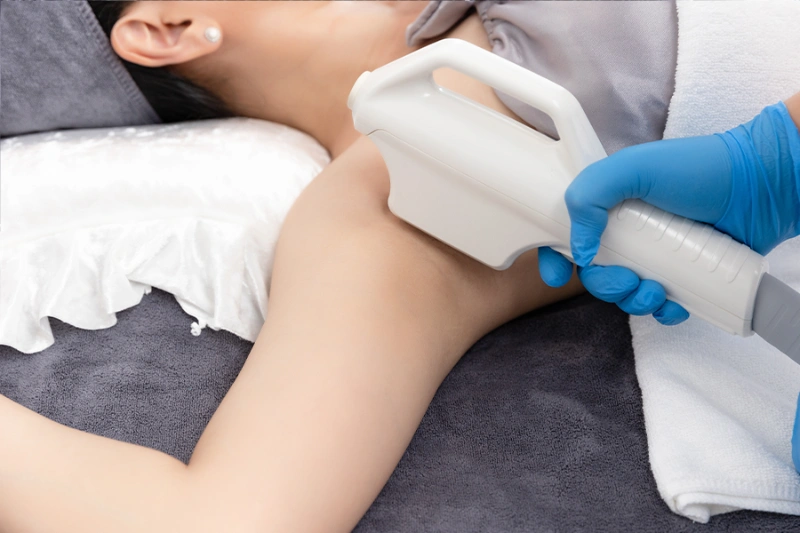 Ưu điểm của triệt lông IPL là gì
