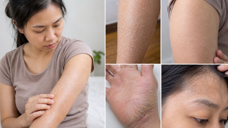 Dấu hiệu nhận biết da vảy cá