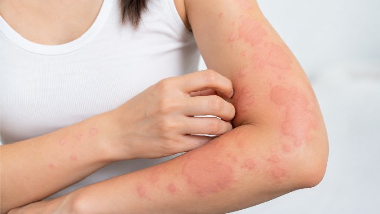 Dấu hiệu nhận biết bệnh mày đay