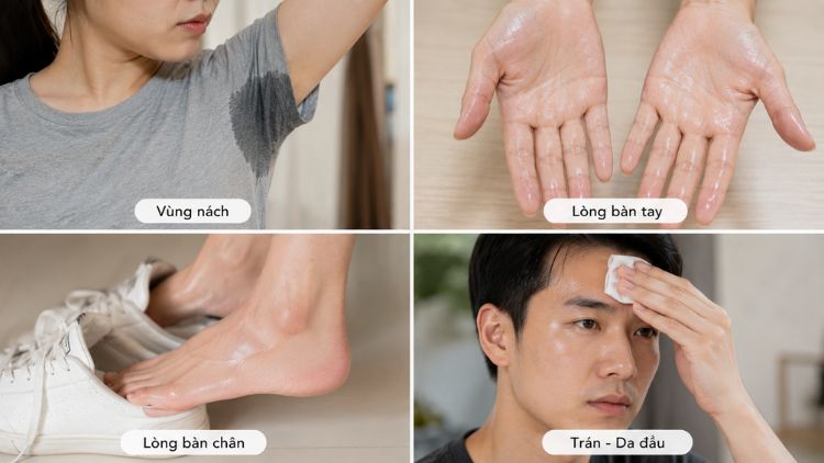 Các vùng có thể tiêm Botox giảm mồ hôi