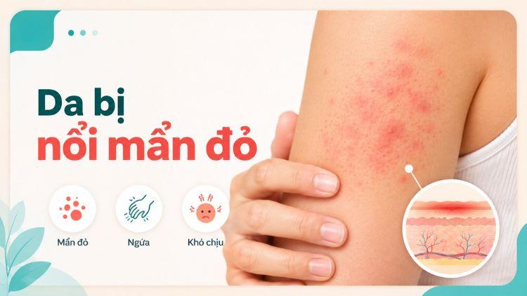 da bị nổi mẩn đỏ