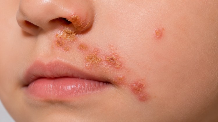 Chốc bọng nước trên da với các mụn nước căng và tổn thương điển hình