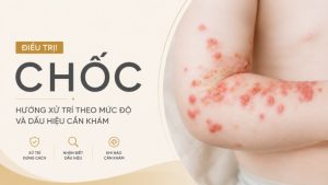 Điều Trị Chốc: Cách Chăm Sóc Và Ngăn Lây | Citrine