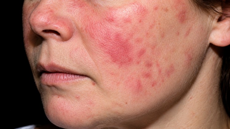 Lupus ban đỏ ở da mặt gây ban đỏ lan rộng vùng má