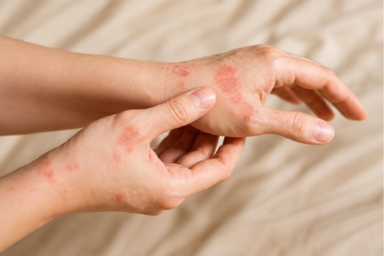 Ban đỏ do lupus xuất hiện trên mu bàn tay