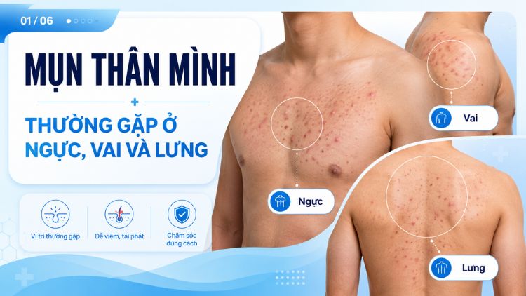 Mụn thân mình thường gặp ở ngực, vai và lưng