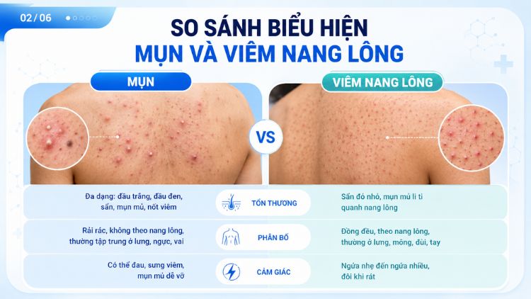 So sánh biểu hiện mụn và viêm nang lông