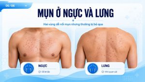 Mụn ở ngực và lưng: Nhận biết đúng tình trạng | Citrine