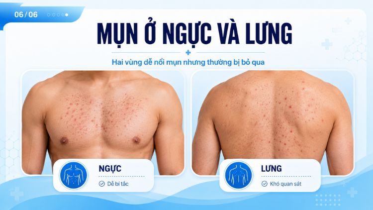 Mụn ở ngực và lưng: Nhận biết đúng tình trạng | Citrine