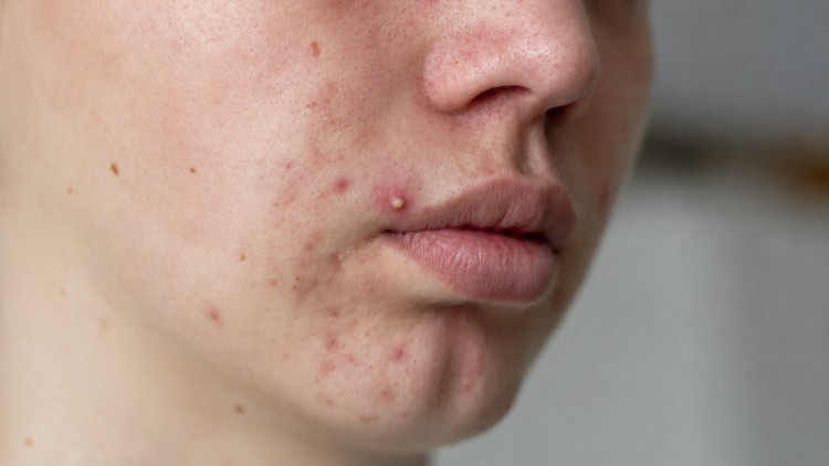 Biểu hiện mụn trứng cá đỏ
