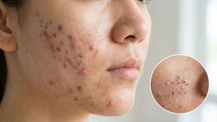 Mụn kéo dài cần được đánh giá và theo dõi