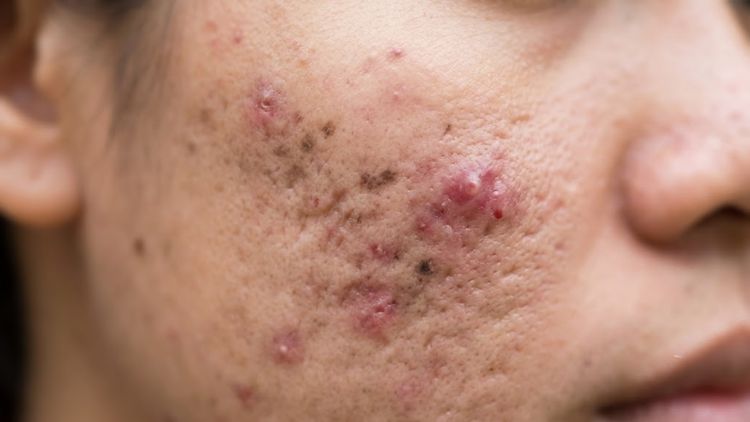 Điều trị mụn trứng cá mạn tính theo giai đoạn | Citrine