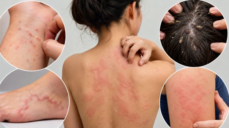 Biểu hiện ký sinh trùng trên da