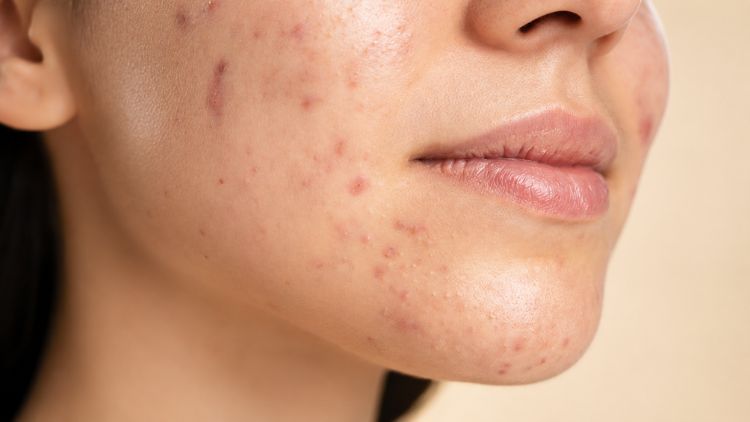 Peel da hóa học hỗ trợ cải thiện mụn, sắc tố và bề mặt da