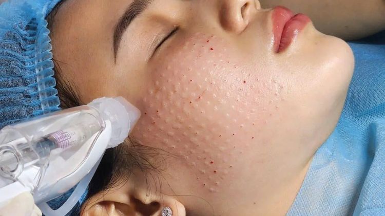 Quy trình tiêm Meso tại Citrine Derma Clinic