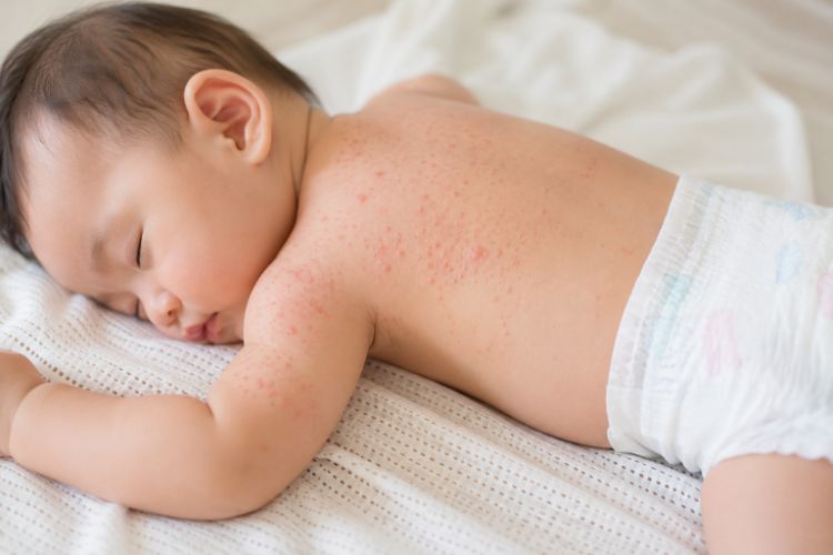 Đặc điểm của rôm sảy ở trẻ