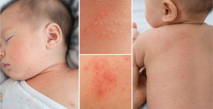 Dấu hiệu nhận biết rôm sảy ở trẻ