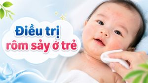 Điều Trị Rôm Sảy Ở Trẻ: Chăm Sóc, Phòng Bội Nhiễm | Citrine