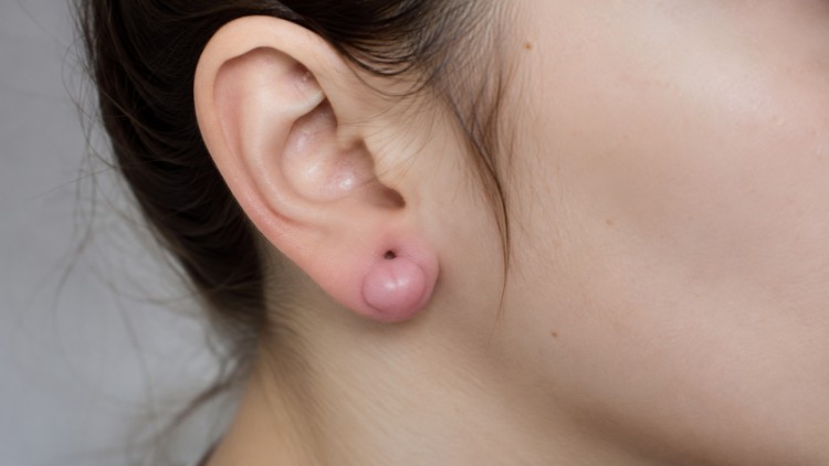 Sẹo lồi ở dái tai hình thành sau tổn thương do xỏ khuyên