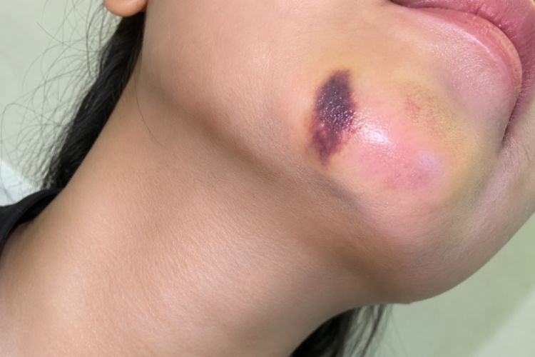 Cách xử lý khi xuất hiện bất thường sau tiêm filler
