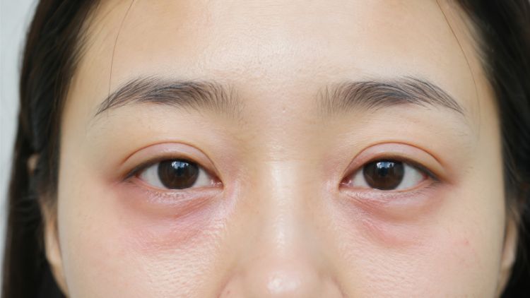 Tác dụng phụ cần theo dõi sau laser