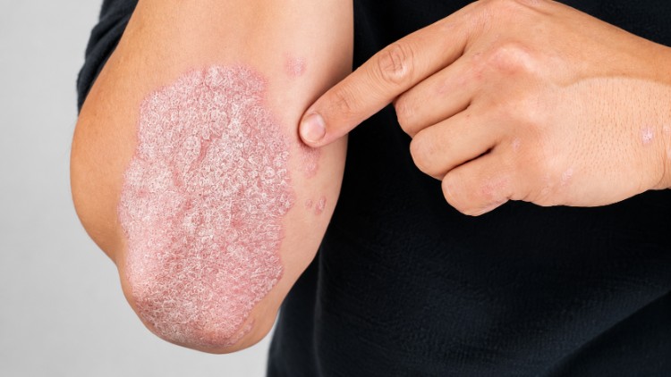 Cận cảnh vùng da bị vảy nến mảng