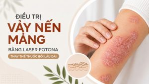 Điều Trị Vảy Nến Mảng Bằng Laser Fotona Thế Nào? | Citrine