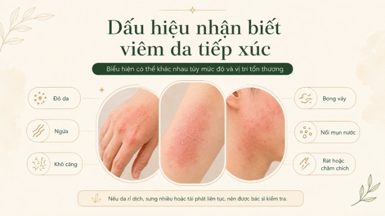 Dấu hiệu viêm da tiếp xúc gồm đỏ, ngứa, bong vảy và mụn nước