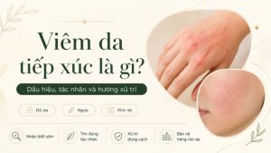 Viêm Da Tiếp Xúc Là Gì? Dấu Hiệu, Xử Trí | Citrine