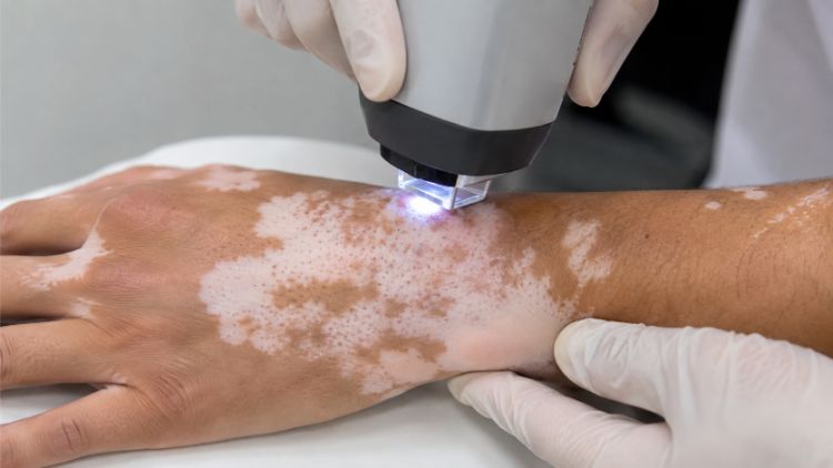 Mỗi phương pháp điều trị bạch biến đều có rủi ro và giới hạn riêng