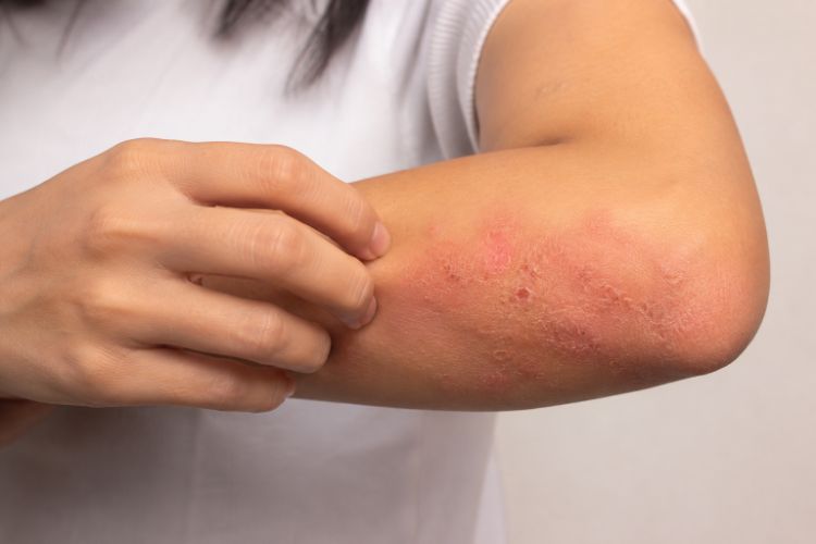 Cơ chế hình thành bệnh chàm trên da