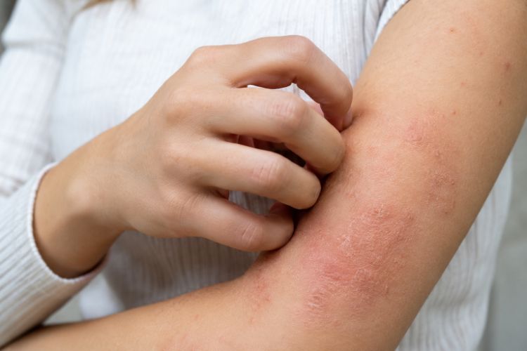 Các dấu hiệu điển hình của bệnh chàm
