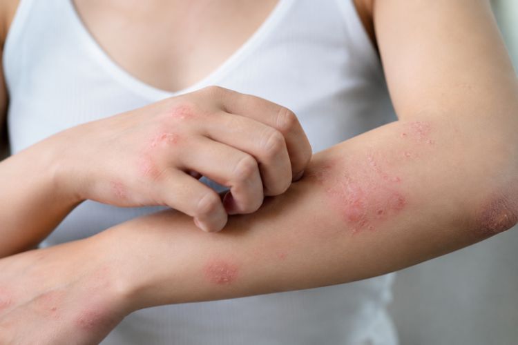 Những biến chứng có thể gặp khi bệnh chàm kéo dài