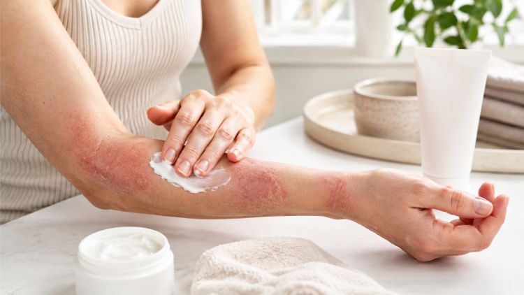 Các nguyên tắc kiểm soát bệnh chàm