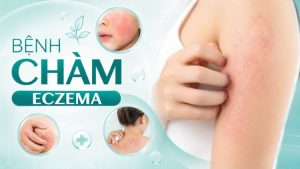 Bệnh Chàm Eczema: Dấu Hiệu, Phân Loại Và Điều Trị