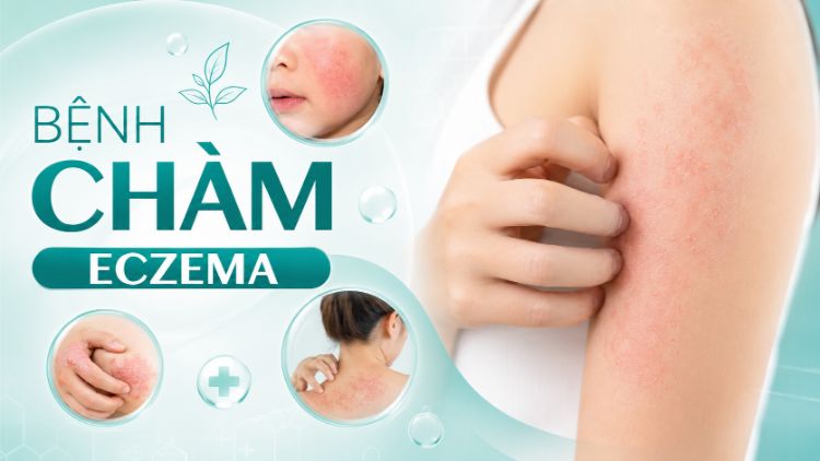 Bệnh Chàm Eczema: Dấu Hiệu, Phân Loại Và Điều Trị