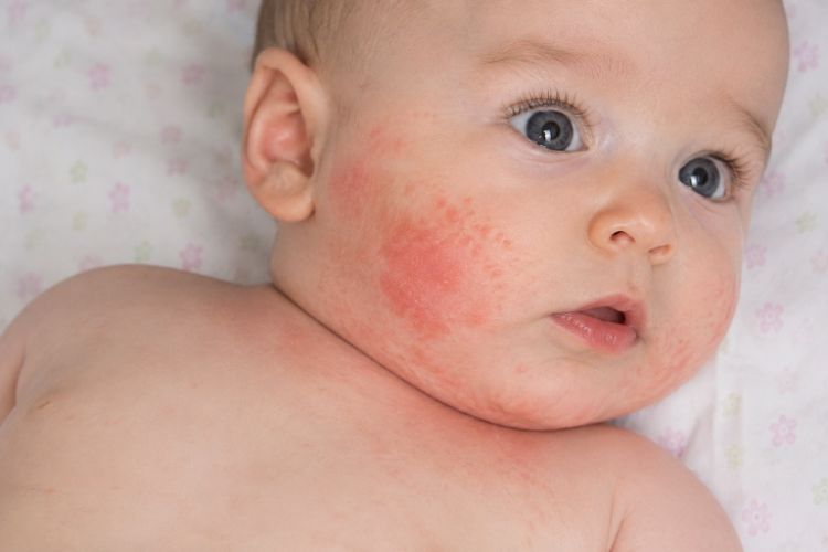 Đặc điểm thường gặp của chàm sữa ở trẻ em