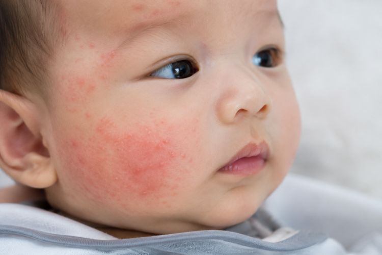 Da khô, đỏ và ngứa do chàm sữa